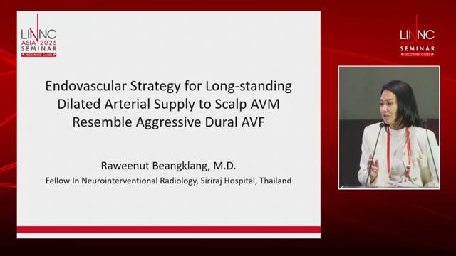Endovascular Strategy for Long-standing Dilated Arterial Supply Aggressive Dural AVF