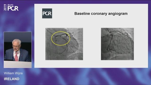 PCI of distal left main