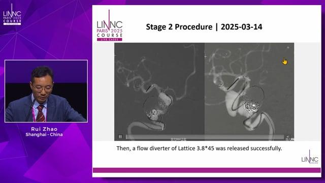 Coiling with Staged Flow Diversion for 