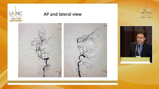 Mechanical thrombectomy for vertebro-basilar artery occlusion