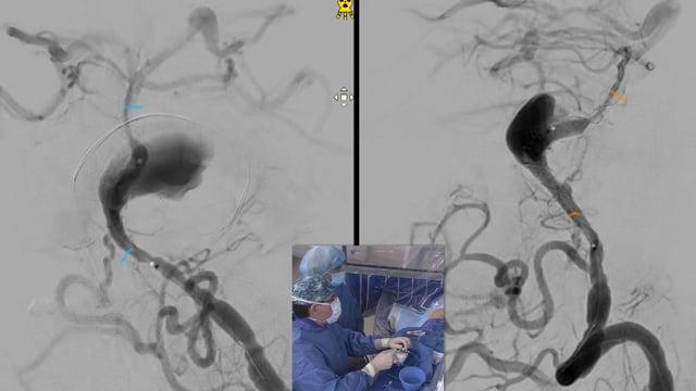 Combined flow diverter and braided stenting treatment of a giant basilar aneurysm