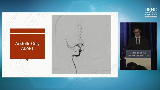 Aristotle®-Only ADAPT: A Novel Technique Utilizing Macrowires for Ischemic Stroke