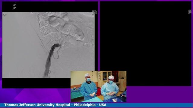 Live Case Transmission from Thomas Jefferson University Hospital, Philadelphia, USA - Catheterization failure in giant fusiform aneurysm