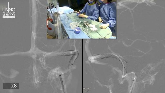 Venous sinus stenting and transcanal recordings for objective assessment of pulsatile tinnitus