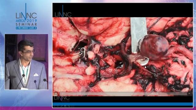 Posterior circulation flow diversion & delayed hemorrhage - Autopsy findings