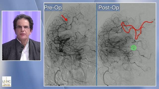 Distal and more distal thrombectomies: is the game worth the candle?