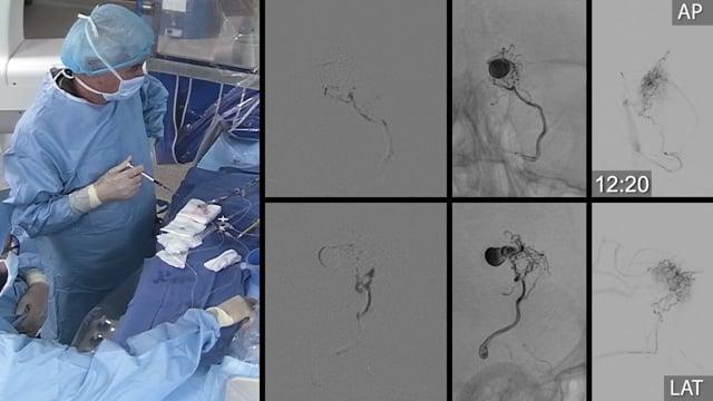 Small ruptured arteriovenous malformation