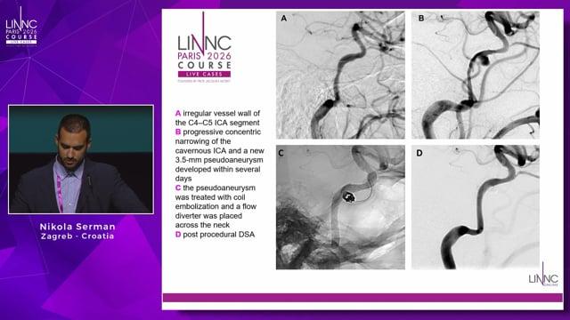 Lips to die for: invasive sino-orbital aspergillosis after dermal filler injections presenting with cavernous sinus thrombosis, ICA stenosis, and pseudoaneurysm