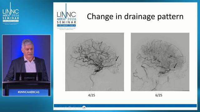 Carotid Cavernous Fistula with Cortical Venous Reflux Treated using a Percuteaneous Inferior Orbital Vein Approach