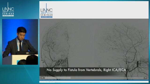 Staged Transarterial and Transvenous Embolization of High Grade Ruptured Tentorial Dural Arteriovenous Fistula