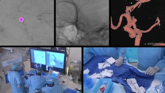 WEB treatment of a ruptured Left Pcom Aneurysm