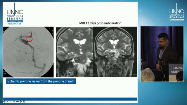 Occlusion of the basilar artery for treatment of partially thrombosed fusiform aneurysm