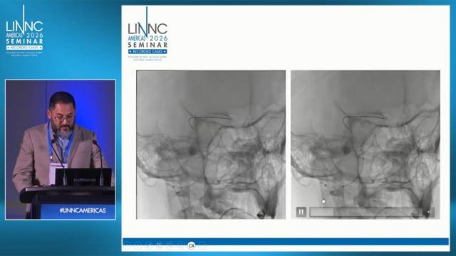 Rescue FD in a complicated vertebro-basilar aneurysm