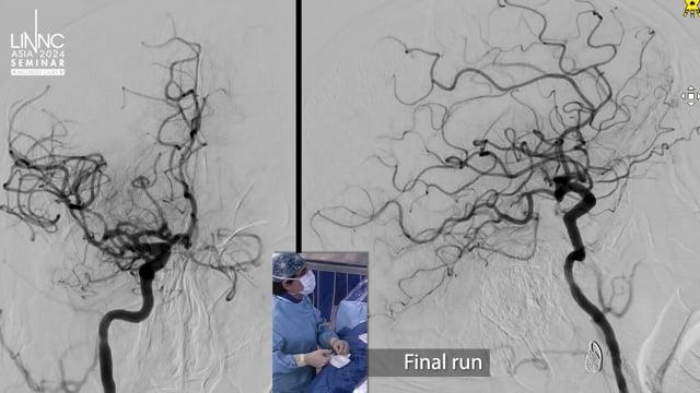 BADDASS approach to right M1 revascularization
