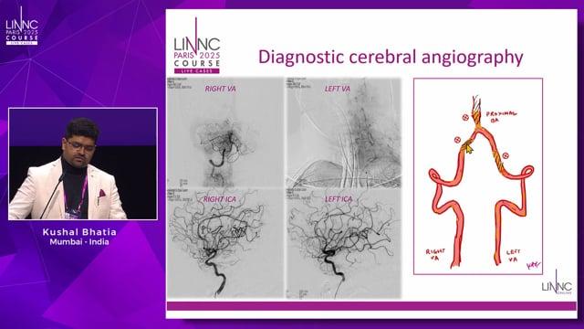 Damned if you do, damned if you don't: Endovascular re-canalization of the vertebrobasilar CTO