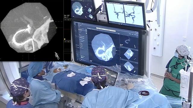 Recorded Cases - Bicêtre Hospital, Paris - Acomm aneurysm treated by intrasaccular CONTOUR device