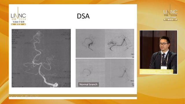Transarterial Curative Embolization of Parietal bAVM