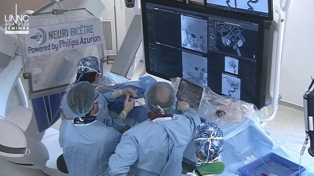 M1 balloon occlusion test for flow diverter planning for recurrent ruptured right MCA aneurysm