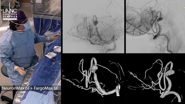 Flow diverter treatment for vertebral artery dissecting aneurysm associated with significant parent vessel stenosis