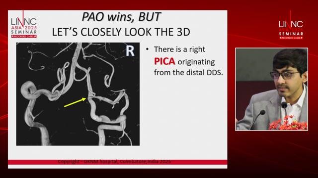 The predicament of duplicated dysplastic vertebral artery (DDS) in the Young with recurrent stroke