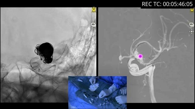 Treatment of a previously ruptured aneurysm with multiple recurrence
