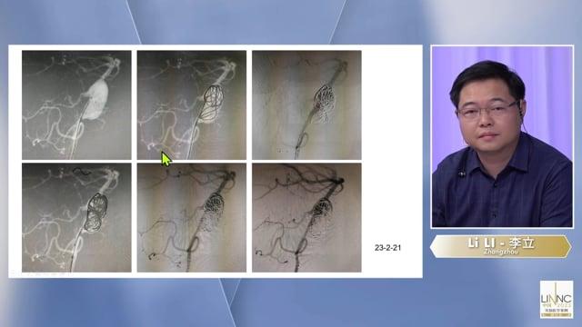 A Bleeding Basilar Artery Dissecting Aneurysm