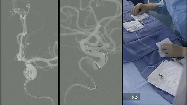 Small anterior communicating artery aneurysm treated with