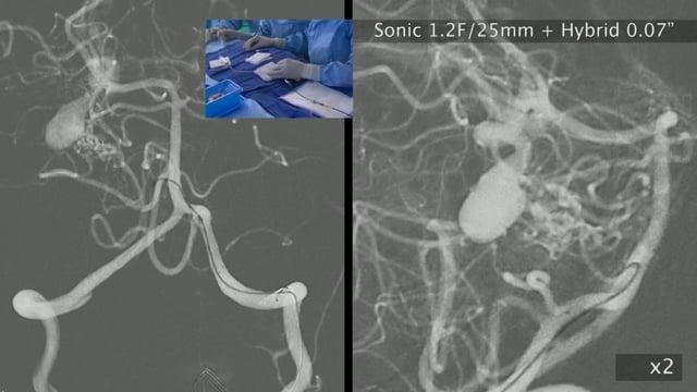 Do all brain AVMs scare us in the same way? Could this be the 