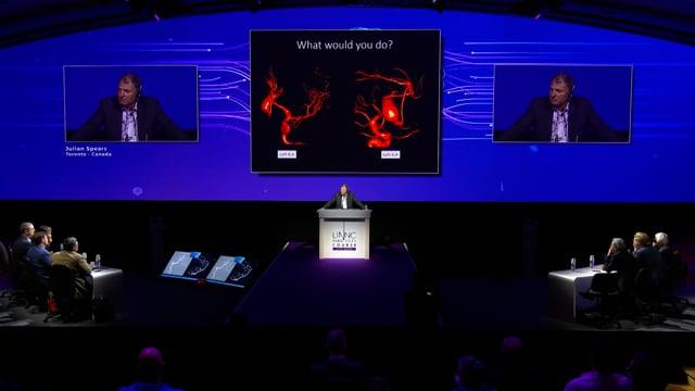 Growing fusiform posterior cerebral artery aneurysm treated with FD