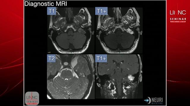 Direct punction of endolymphatic tumor