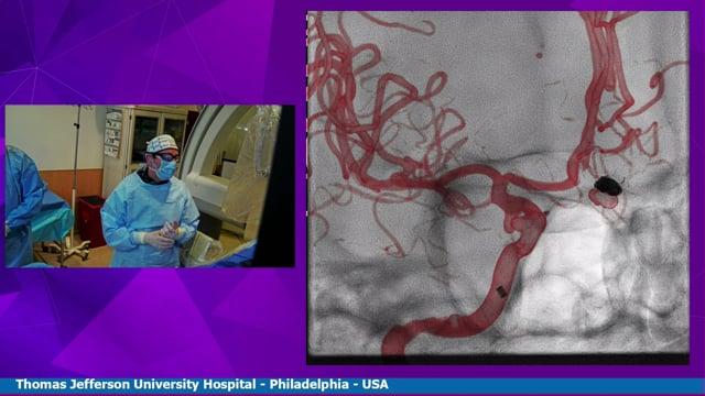 Live Case Transmission from Thomas Jefferson University Hospital, Philadelphia, USA - Treatment of an unruptured PCOM aneurysm with a flow diverter