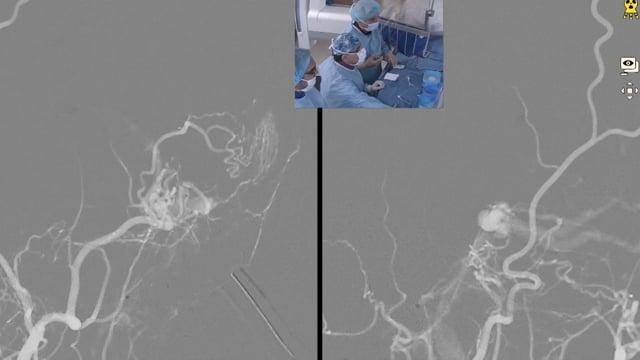 Recorded Cases - Bicêtre Hospital, Paris - Trans-venous treatment of an indirect Carotid-Cavernous Fistula using Tetracoils and Phil