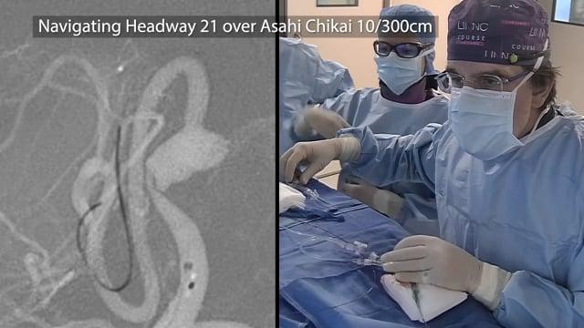 Vantage case sharing - dissecting aneurysm treatment