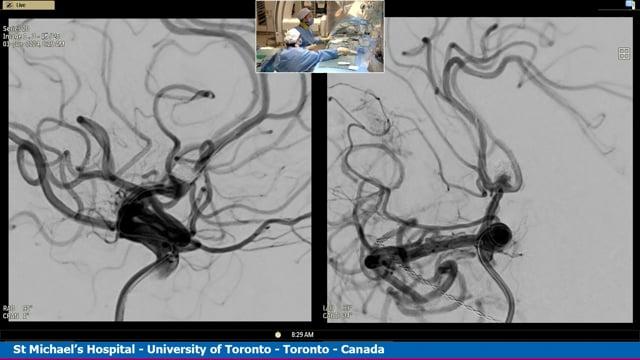 Live Case Transmission from St Michael's Hospital, Toronto, Canada - WEB treatment of a recurrent coiled aneurysm