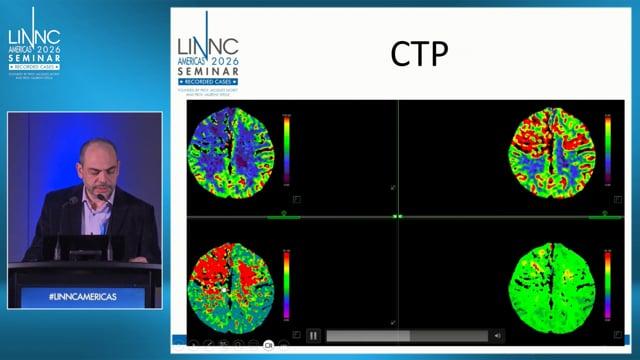 Atypical Presentation of a High Grade dAVF Presenting with Severe Spasticity