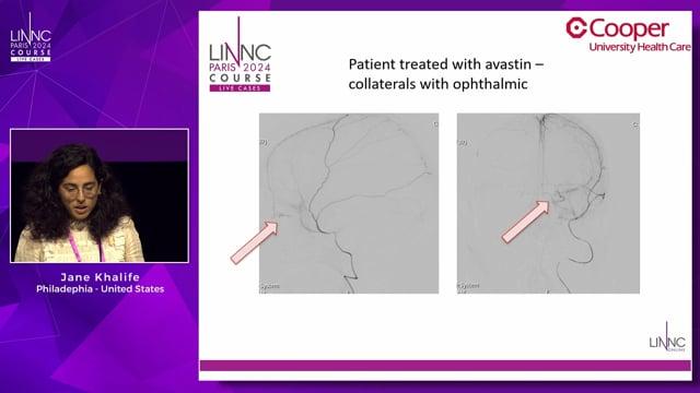 Intraarterial Bevacizumab Administration Through the Middle Meningeal Artery for Chronic Subdural Hematoma