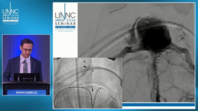 Kissing WEBs in a Giant Basilar Tip Aneurysm