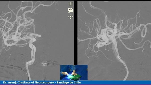 Right MCA aneurysm