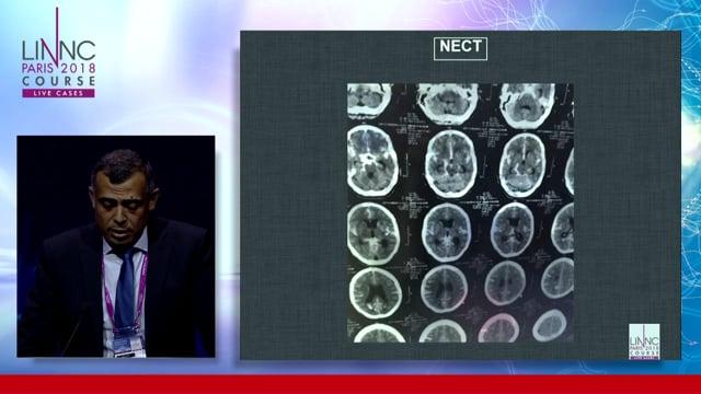 Flow diverter treatment in acute SAH in Supraclinoid dissecting ICA aneurysm