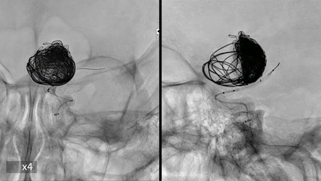 Recorded Cases - St Michael's Hospital, Toronto -Re-treatment of a giant paraclinoid aneurysm guided by nOCT: HQ Intraluminal imaging provide 