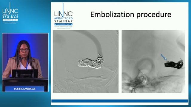 Endovascular Management of a High-Flow Pial Arteriovenous Fistula in a 9-Month-Old Infant