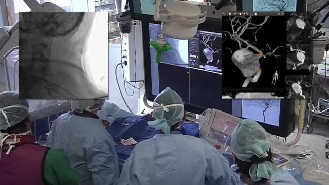 Ischemic stroke & Aneurysm treatment : Giant intra-cavernous right ICA aneurysm