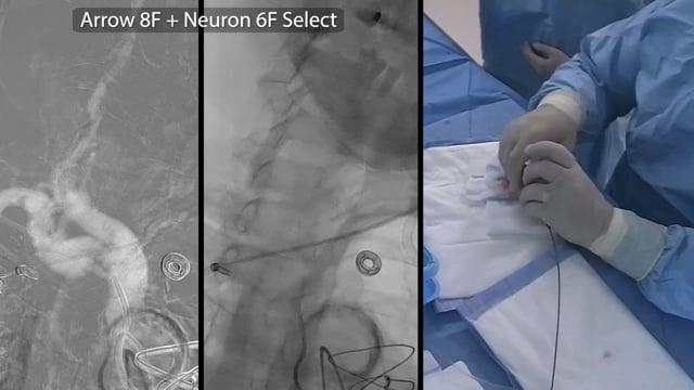 Mechanical thrombectomy for right MCA tandem occlusion in a wake-up stroke patient