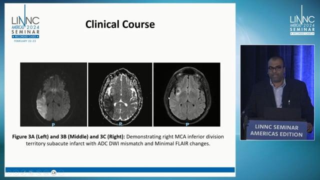 Crossed Broca's Aphasia In Setting Of Thrombosed Right MCA Aneurysm