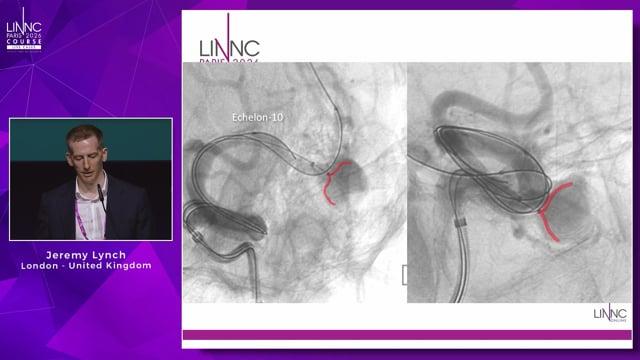 Complex MCA aneurysm treated with cocojambo plus