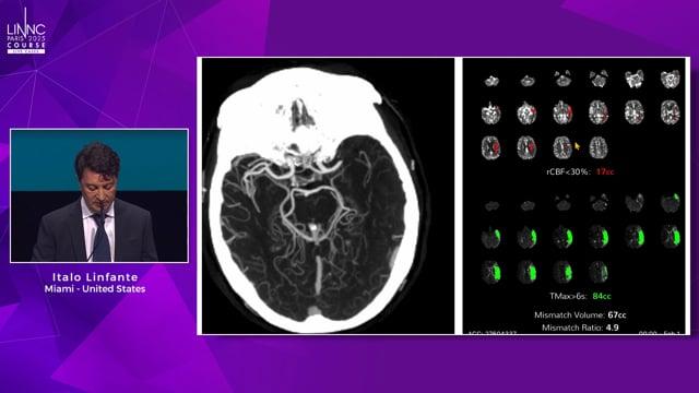 Hemera-1: Novel neuroprotection strategy in stroke