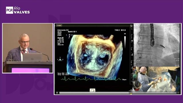Management of residual