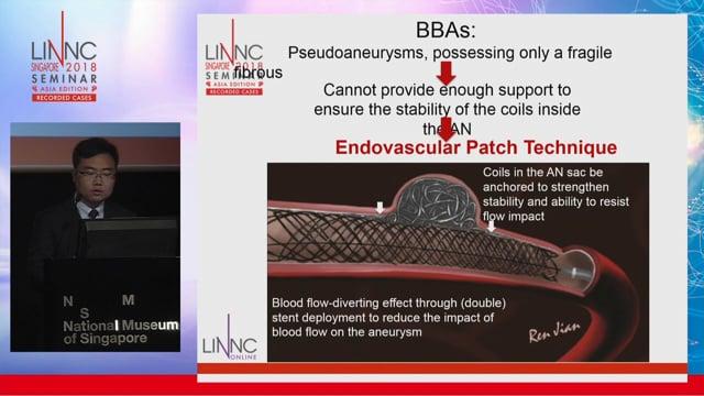 Endovascular patch embolization for BBA in ICA dorsal segment