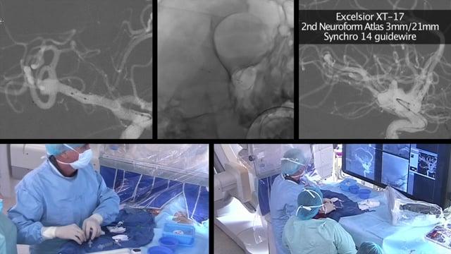 To treat or not to treat? A flat, short-necked right MCA bifurcation aneurysm