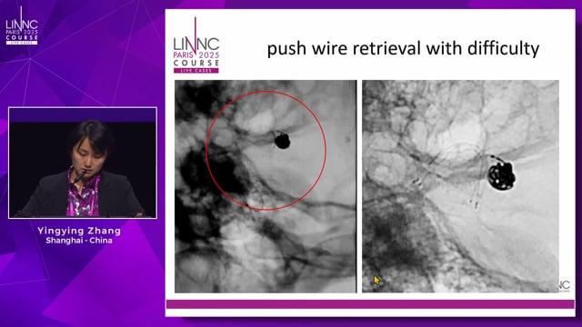 EVT For Ruptured PICA Aneurysm